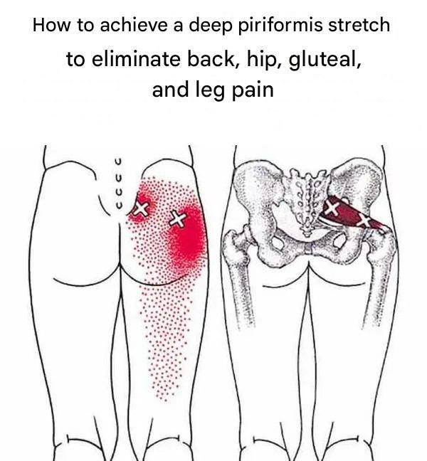Piriformis Stretches to Relieve Piriformis Syndrome