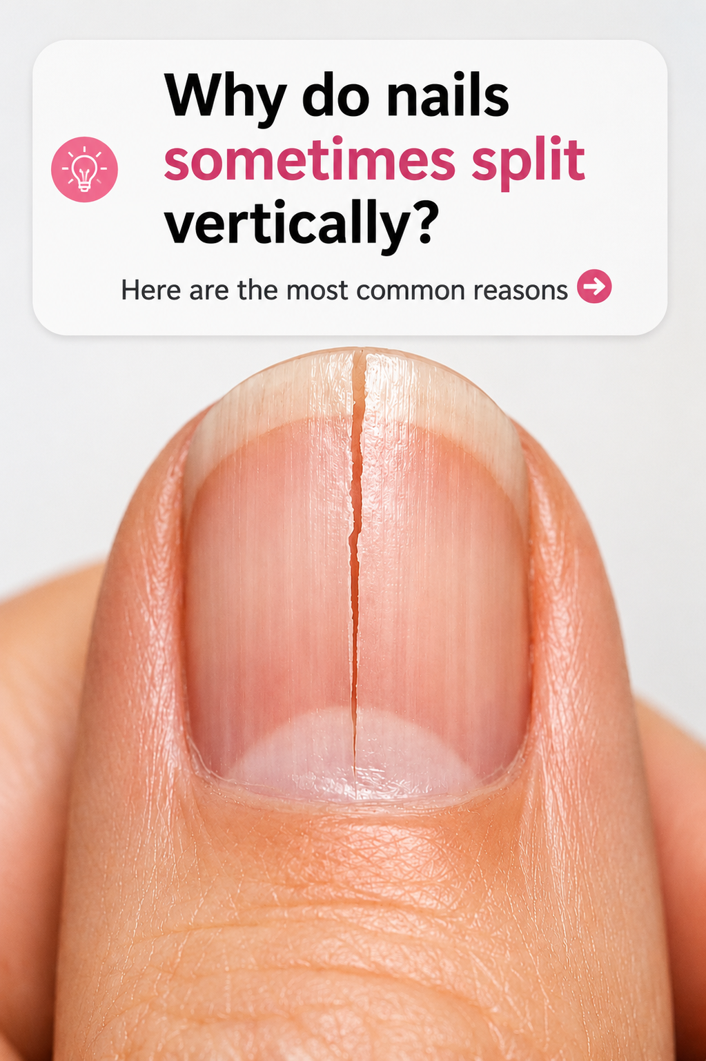 Why Do Fingernails Split Straight Down Instead of Chipping?